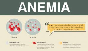 Anemia: Symptoms, Causes, Types, and Treatment Explained