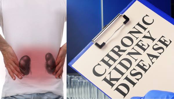 Chronic Kidney Disease: Early Signs You Shouldn’t Ignore
